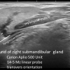 stone not seen on CT US or sialogram