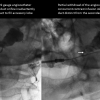inadvertent cannulation of secondary duct to accessory lobe of parotid
