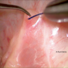 SMG cannulation with Prolene and 26 gauge angio