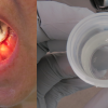 floor of mouth mucus retention cyst with rupture (mucus extravasation phenomenon).