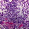 Inflammation is predominantly or exclusively composed of lymphocytes (a minor proportion of plasma cells is allowed) centered around acini as seen here