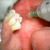 laser sialendoscopy for parotid stone