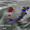 stone not seen on CT US or sialogram