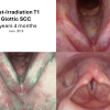 T1 post XRT long term sequence