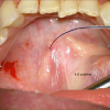 SMG cannulation with Prolene and 26 gauge angio