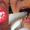 floor of mouth mucus retention cyst with rupture (mucus extravasation phenomenon).