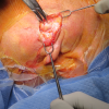 Lymphadenoma parotid