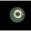 laser sialendoscopy for parotid stone