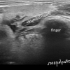 stone not seen on CT US or sialogram