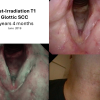 T1 post XRT long term sequence