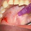 SMG cannulation with Prolene and 26 gauge angio
