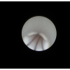 laser sialendoscopy for parotid stone