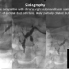 stone not seen on CT US or sialogram
