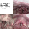 T1 post XRT long term sequence