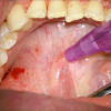 SMG cannulation with Prolene and 26 gauge angio