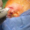 Lymphadenoma parotid