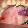 SMG cannulation with Prolene and 26 gauge angio