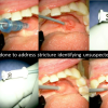 stone not seen on CT US or sialogram