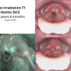 T1 post XRT long term sequence