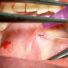 SMG cannulation with Prolene and 26 gauge angio