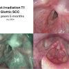 T1 post XRT long term sequence