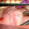 SMG cannulation with Prolene and 26 gauge angio