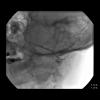 Stenson's duct on parotid sialogram (Image from Iowa Head and Neck Protocols)