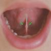 Sublingual Caruncula and orifice adjacent to the frenulum (Created by and used with permission from Hellerhoff)