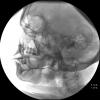 Wharton's duct on submandibular sialogram (Image from Iowa Head and Neck Protocols)