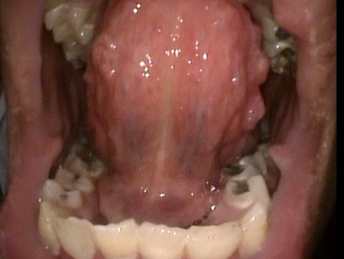 MEN 2b intraoral mucosal neuromas MEN2b intraoral mucosal neuromas