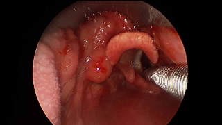 033 vcyst