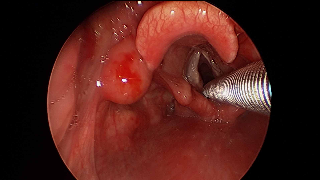 034 vcyst