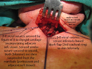 038 intraop