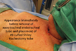 041 intraop