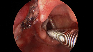 043 vcyst