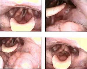 053 vcyst one montha