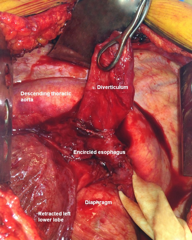 Esophageal diverticula midesophageal  and epiphrenic dissection with diverticulum exposed and chest anatomy demonstrated