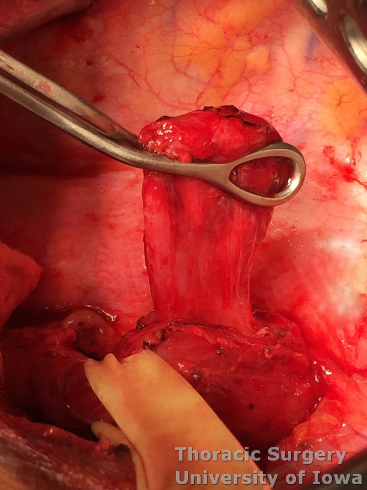 Esophageal diverticula midesophageal  and epiphrenic  symptomatic diverticulum pulsion diverticulum esophagus