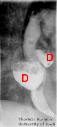 Esophageal diverticula midesophageal  and epiphrenic  synchronous multiple symptomatic  esophagram