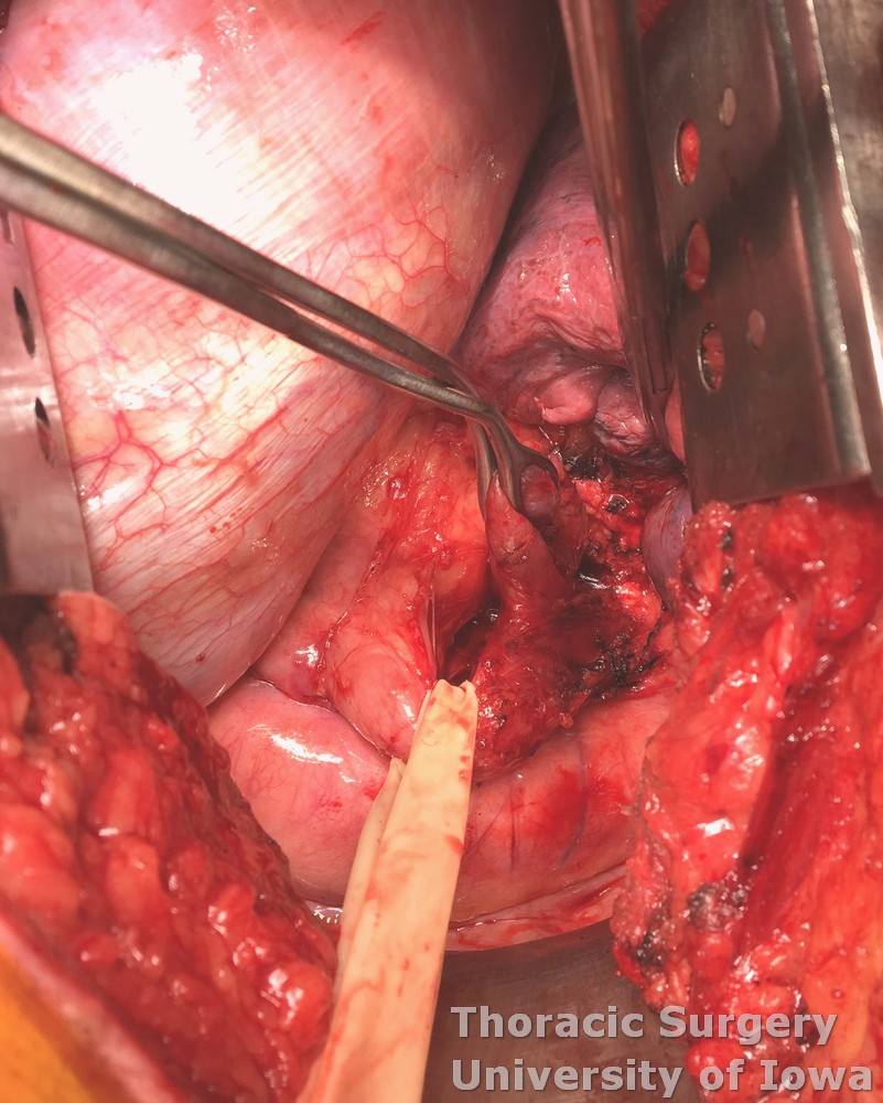 Esophageal diverticula midesophageal  and epiphrenic dissection and retraction for exposure for diverticulectomy