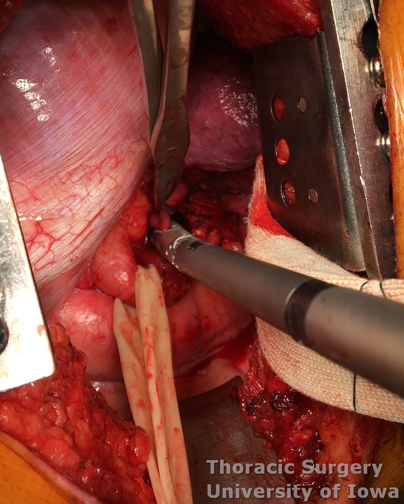 Esophageal diverticula midesophageal  and epiphrenic diverticulectomy with the stapler