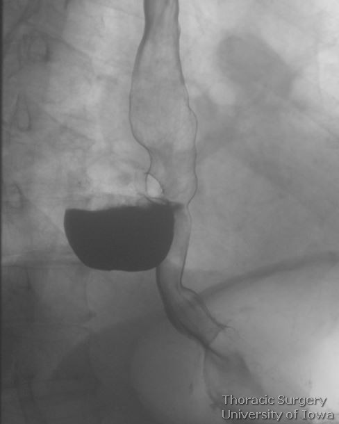 Esophageal diverticulum  large epiphrenic  symptomatic  esophagram contrast retention