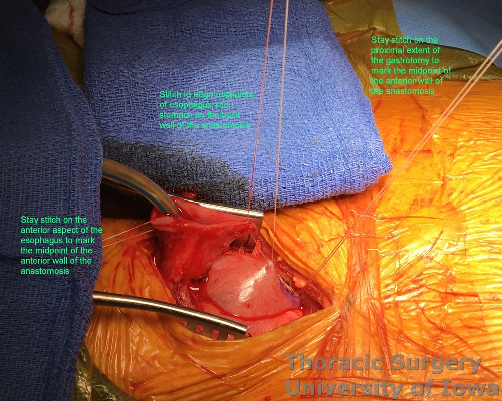 Esophagectomy Interrupted full thickness sutures are placed to align the midpoints of the posterior and anterior walls of the  cervical anastomosis