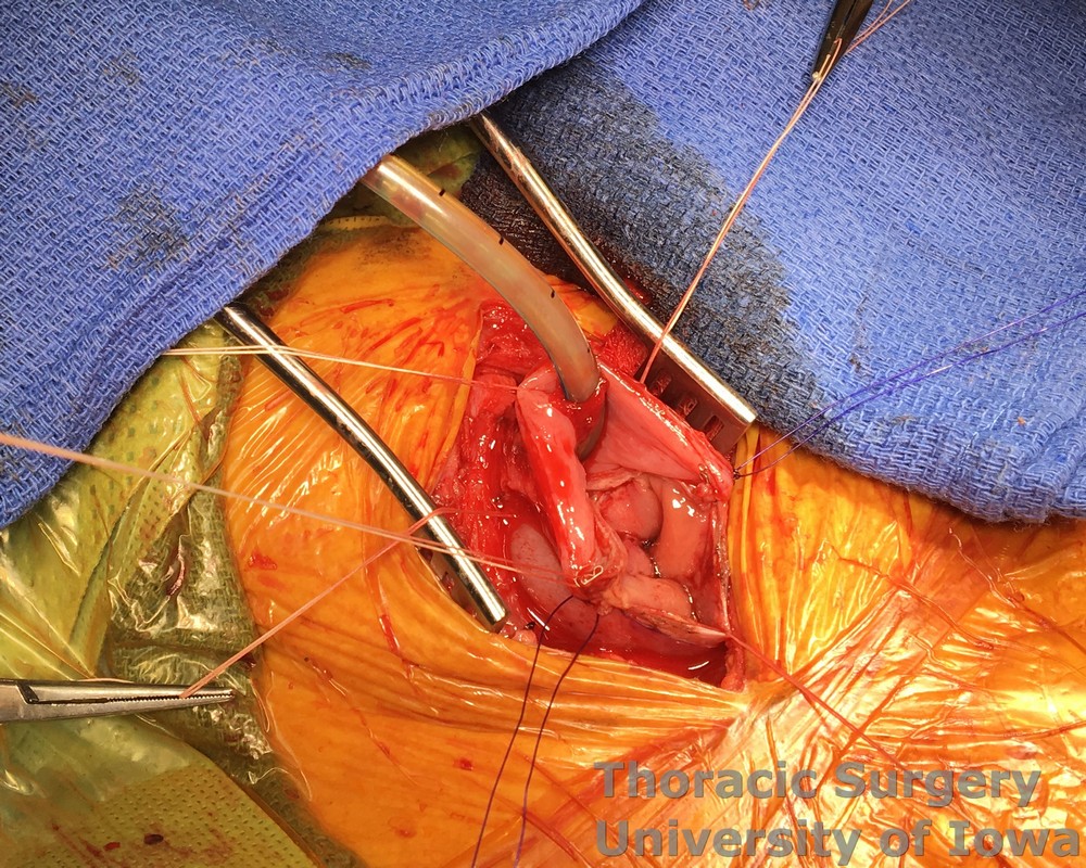 Esophagectomy cervical gastro esophageal anastomosis modified Collard technique as described by Orringer Stapler is fired to create the back wall of the anastomosis