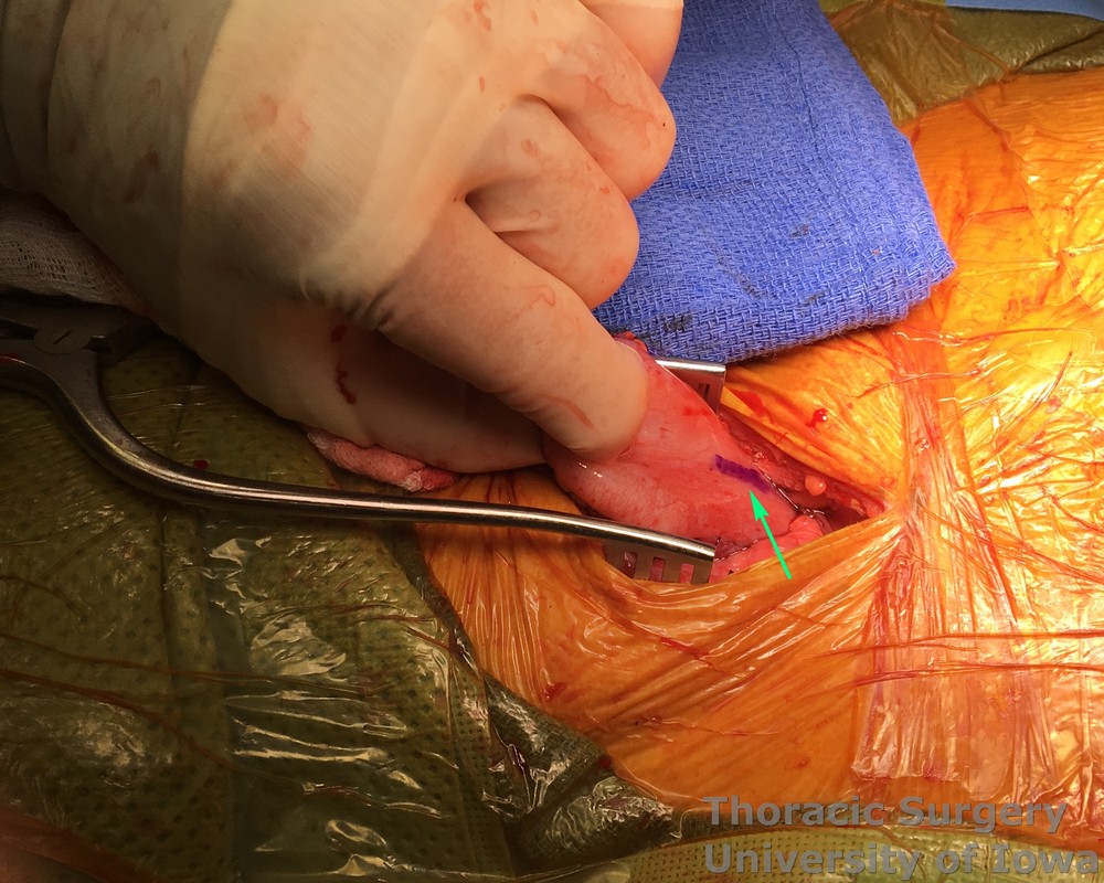 Esophagectomy for esophageal carcinoma cervical gastro esophageal anastomosis Gastrotomy site is marked 3 cm distal to the tip of the staple line