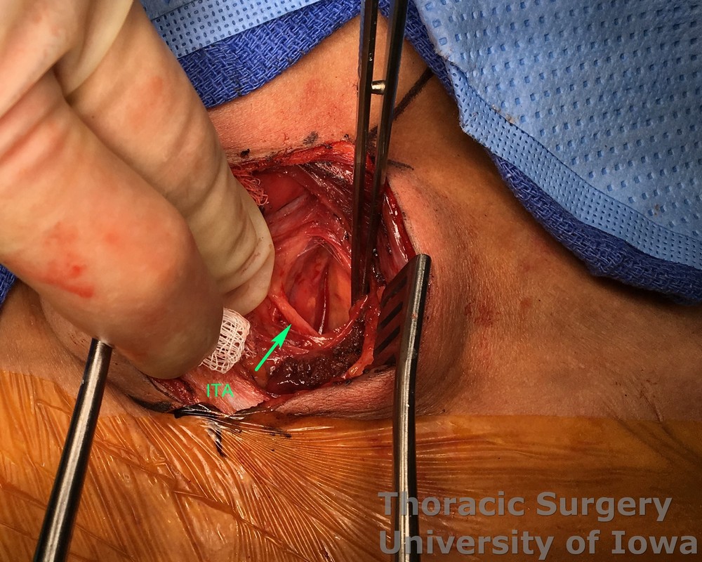 Esophagectomy for esophageal carcinoma cervical gastro esophageal anastomosis Inferior thyroid artery needs to be divided