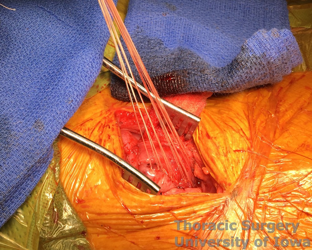 Esophagectomy for esophageal carcinoma cervical gastro esophageal anastomosis Interrupted seromuscular sutures are used for the outer layer
