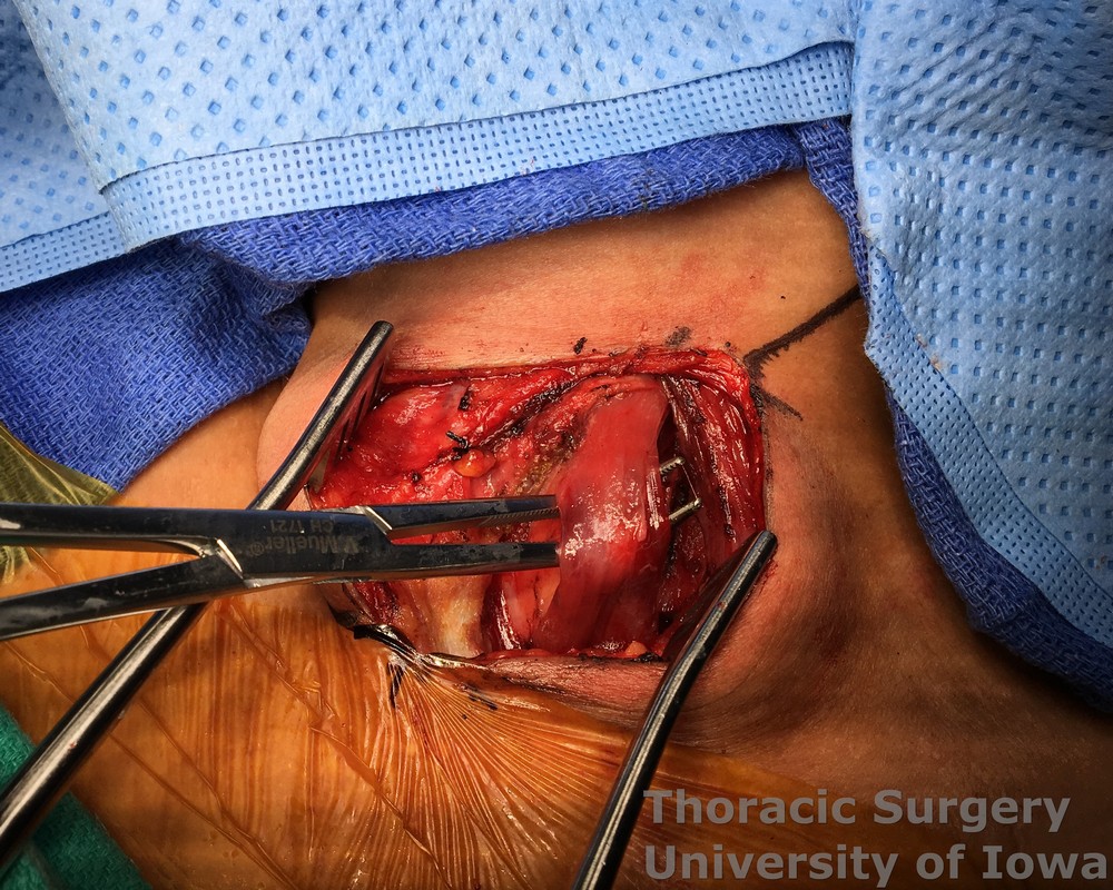 Esophagectomy for esophageal carcinoma cervical gastroesophageal anastomosis Strap muscles are dissected and divided