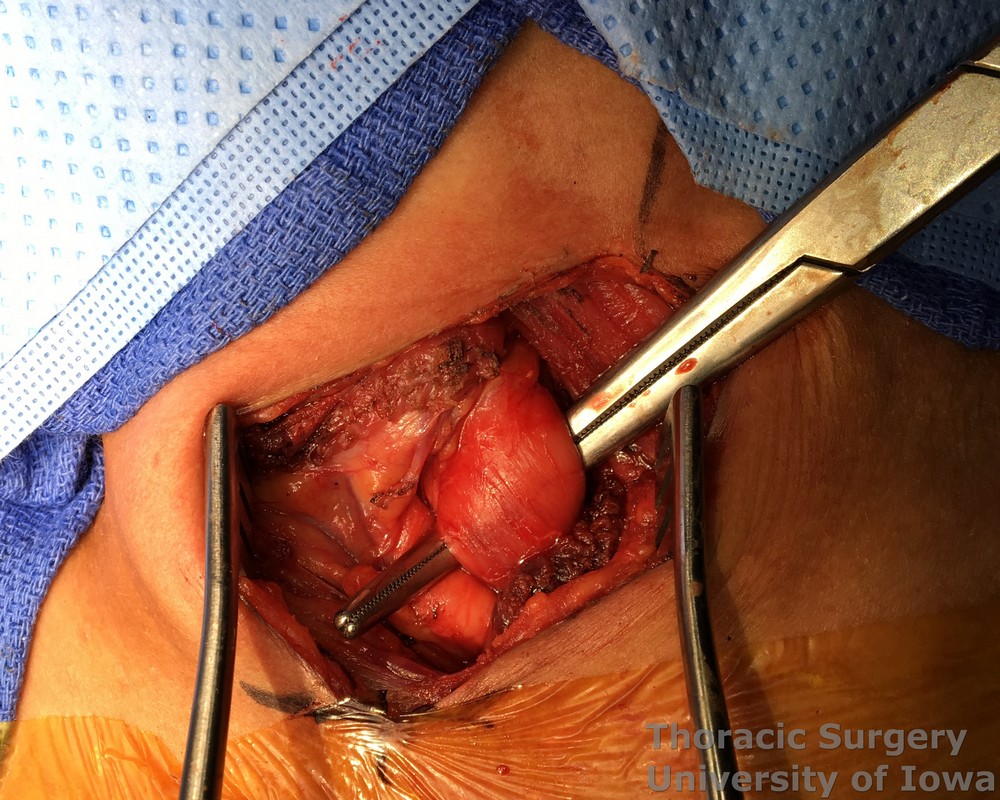 Esophagectomy for esophageal carcinoma cervical gastro esophageal anastomosis The deep cervical fascia is incised and esophagus is  mobilized circumferentially