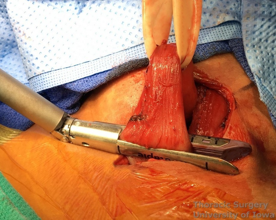 The esophagus is generously mobilized out of  the superior mediastinum and divided